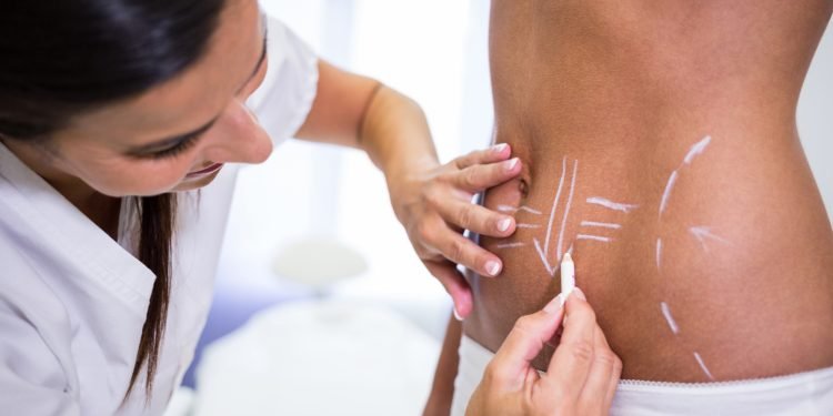 Close-up of surgeon drawing lines on womans abdomen for liposuction and cellulite removal